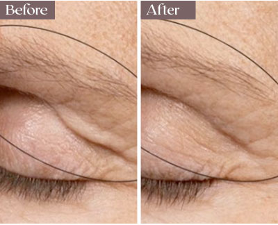 thermage before after nyc